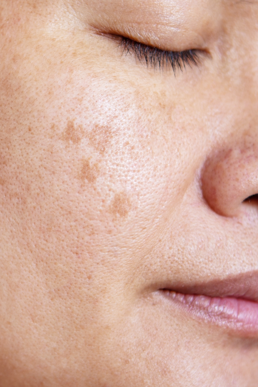 Dull & Uneveven Skin Tone