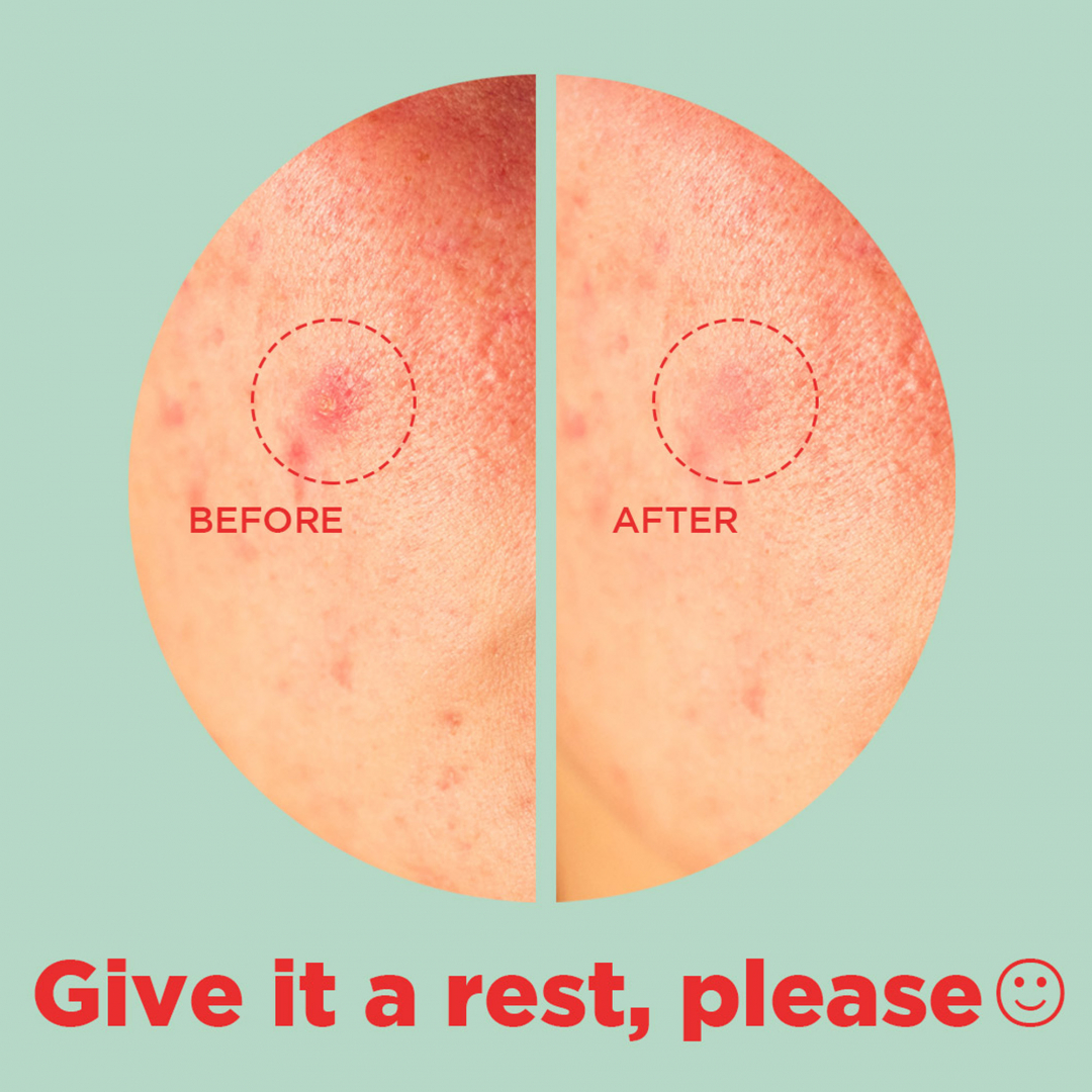 Tea Tree Clear – Dot Patch_06