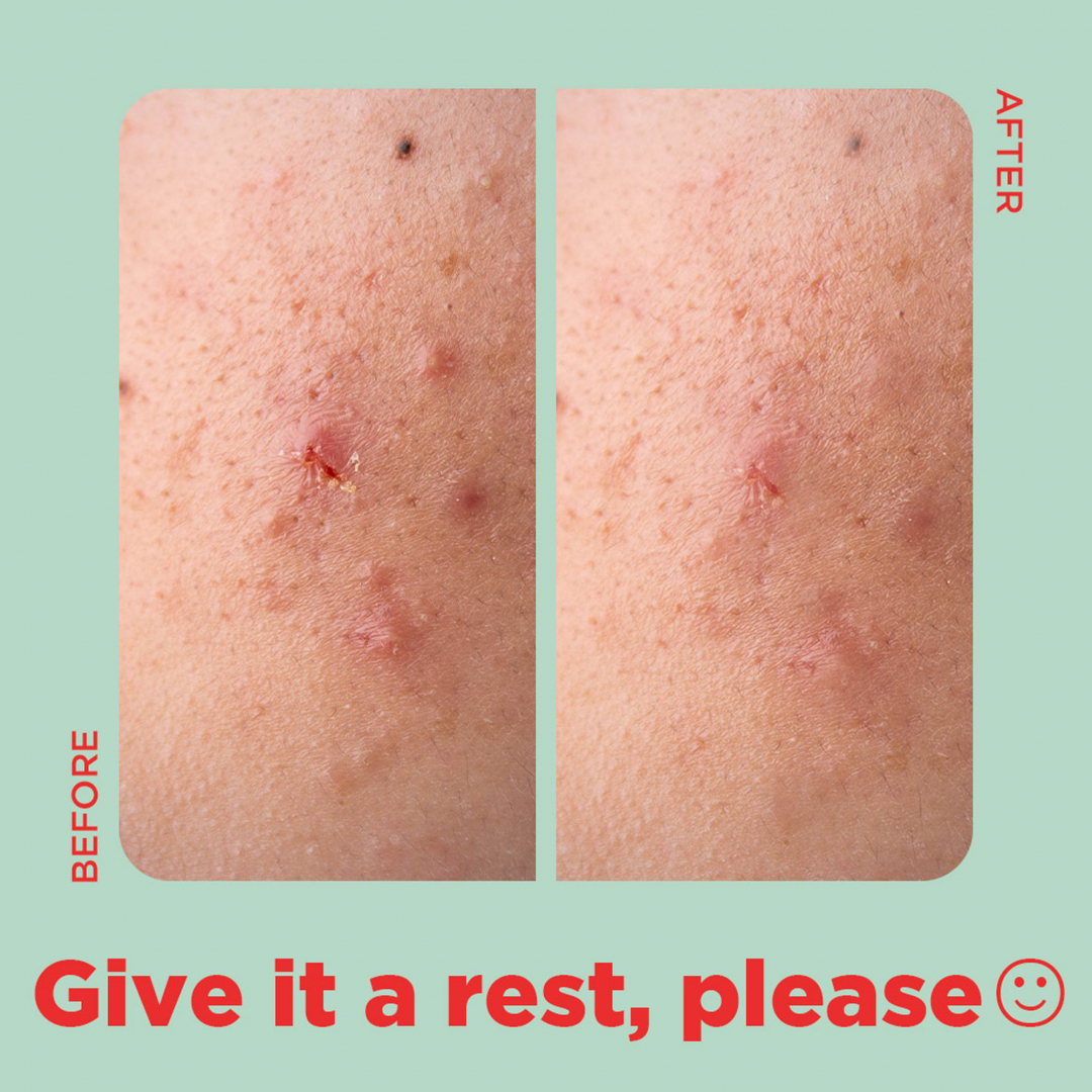 Tea Tree Clear – Square Patch_07